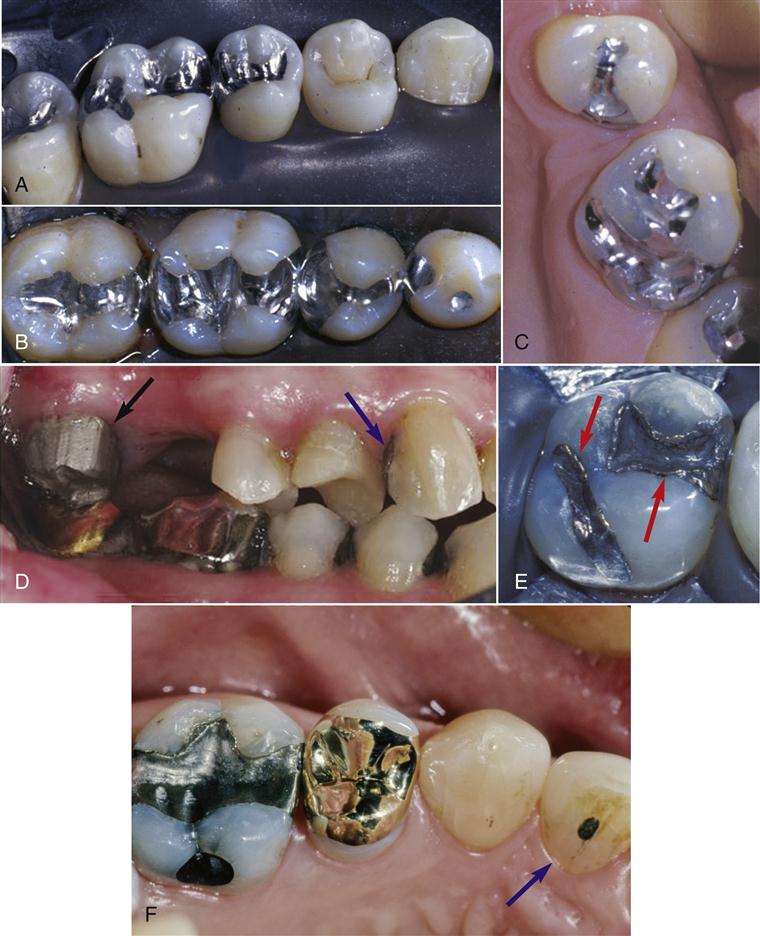 牙科嵌体的处理,牙科医生讲义