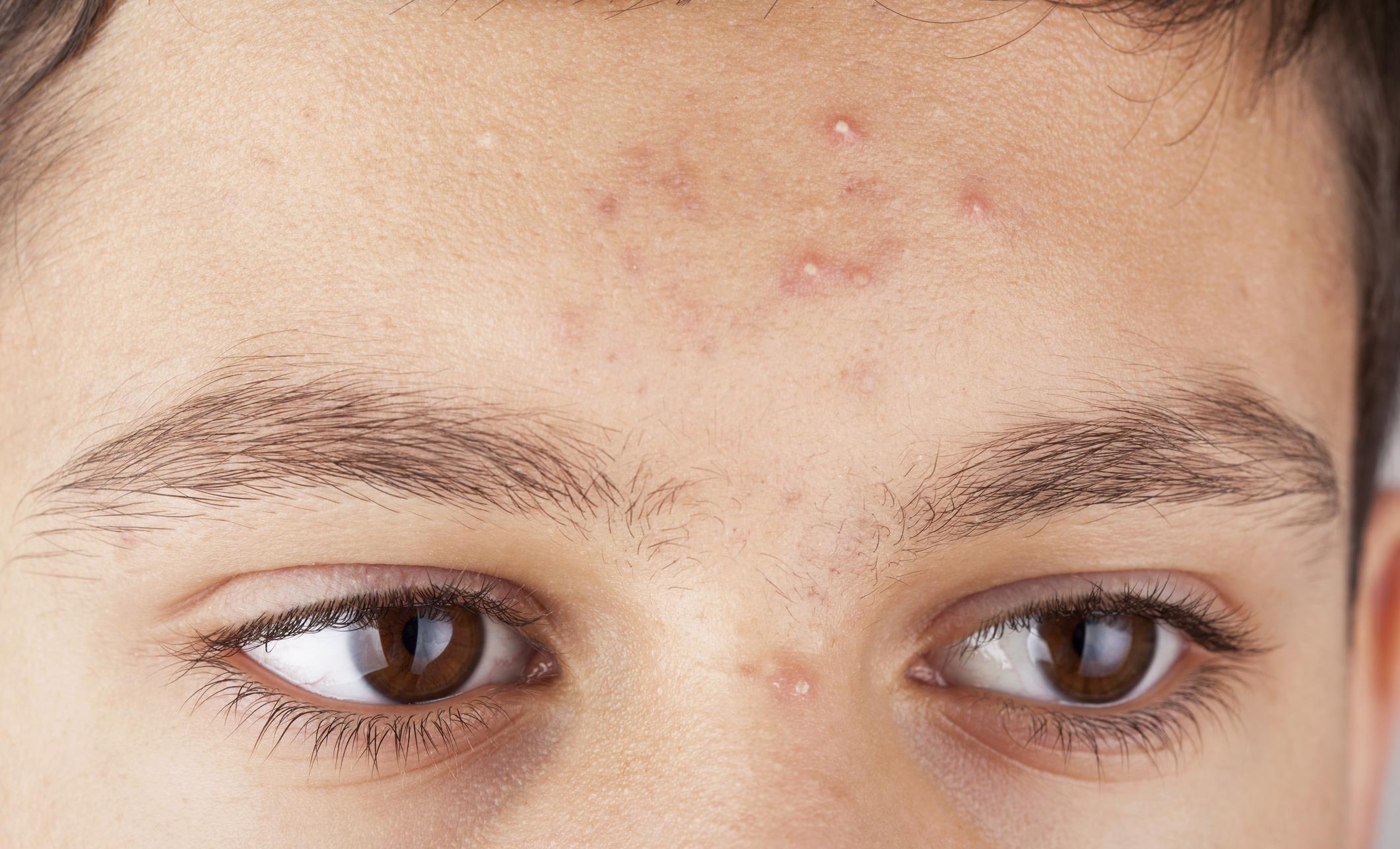 脸部长痘对应五脏六腑,长痘位置对应五脏六腑