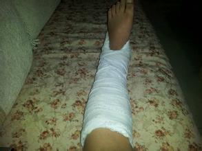 浅谈踝关节扭伤与创伤性关节炎,踝关节扭伤包扎