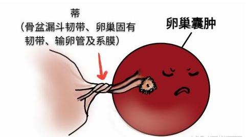 孕晚期突发腹痛:当心卵巢肿瘤扭转