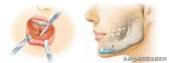 丰下巴的假体需要取出来吗？