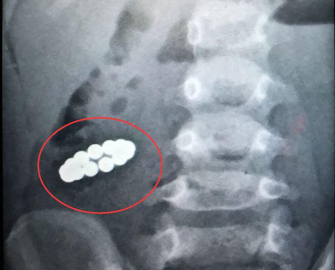 6岁小孩不小心吞了钉子怎么办,7岁儿童误吞铁珠子