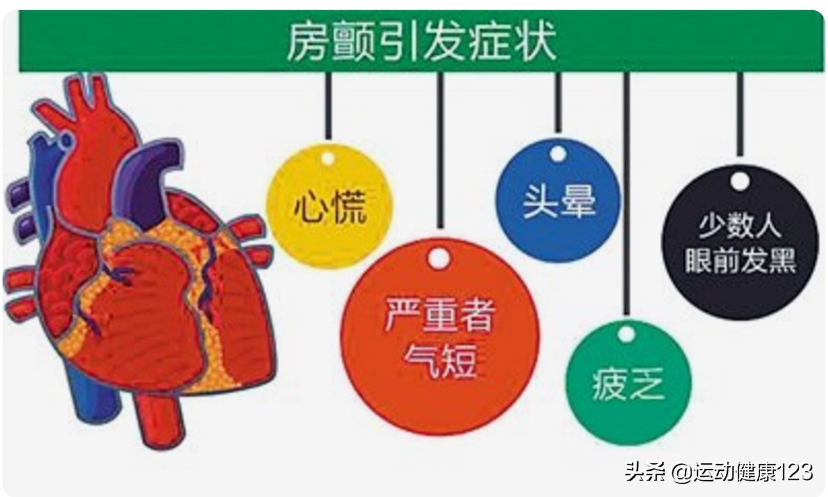 心血管科优势病种心房颤动,心血管专家心房颤动