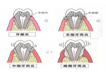 嵌体补牙的缺点,嵌体的优点和缺点简单概括