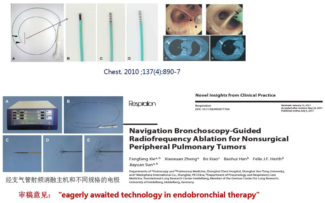 孙加源门诊,治疗肺癌的新技术新手段
