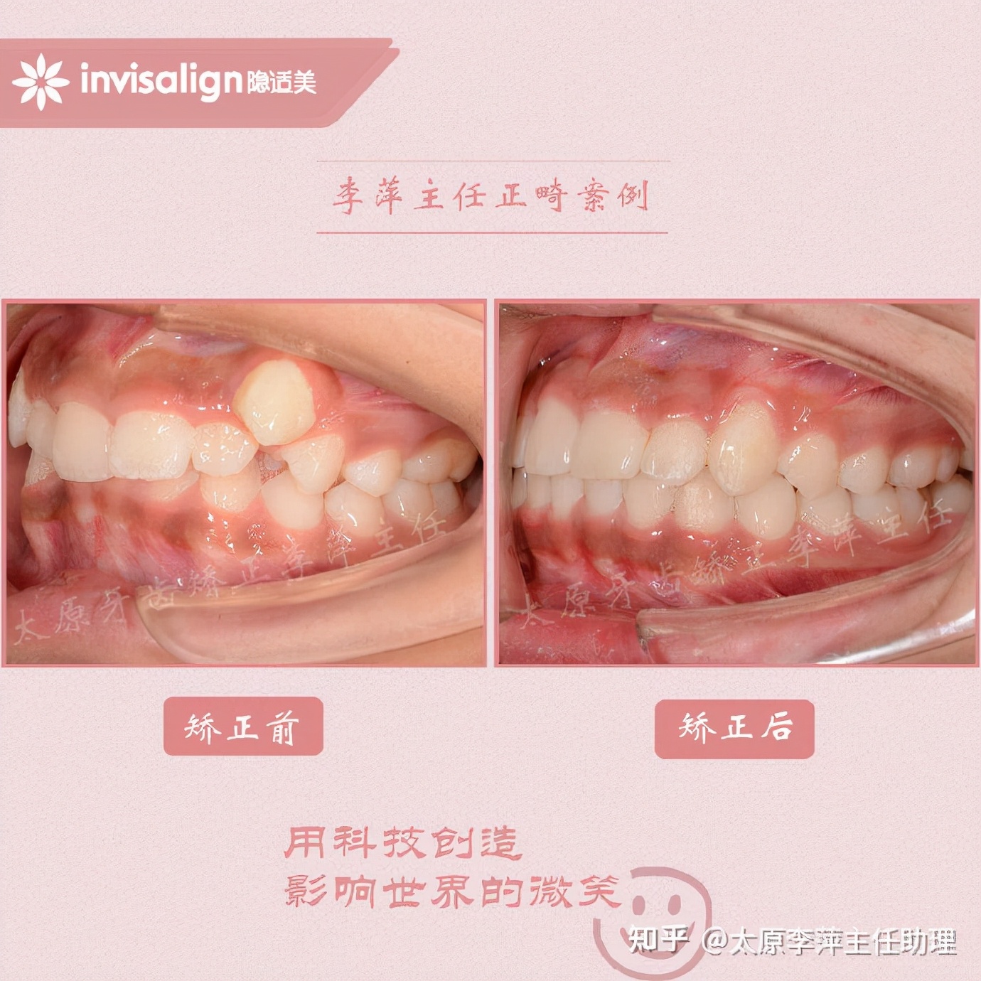 重度拥挤矫正牙齿适合隐形牙套吗,广州成人牙齿矫正推荐隐形牙套