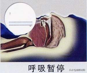 健康科普堂|打鼾反复憋醒,当心睡眠呼吸暂停低通气综合征