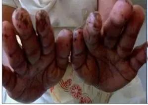 嘴唇黑斑是黑斑息肉综合症吗,黑斑息肉病建议要孩子吗