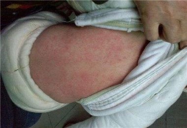 湿疹5个护理方法大家一起看一看,三个月大宝宝湿疹严重怎么护理