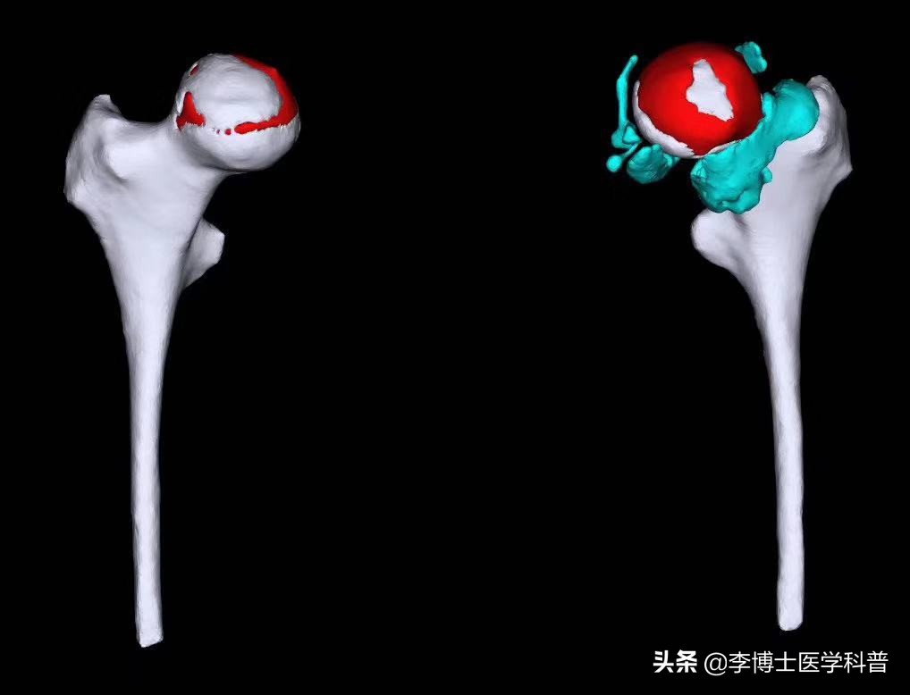 骨头摔折了3年没长上你说怎么办？其它方式不行，我们还有冲击波