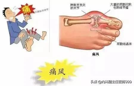 苯溴马隆降尿酸效果副作用怎么样,苯溴马隆降尿酸效果不明显