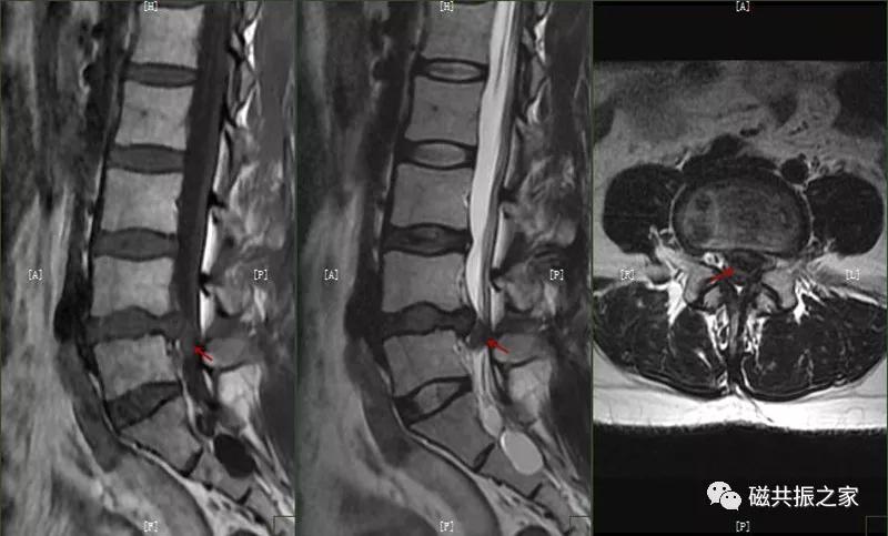 腰椎有哪些病变,腰椎病变有几种