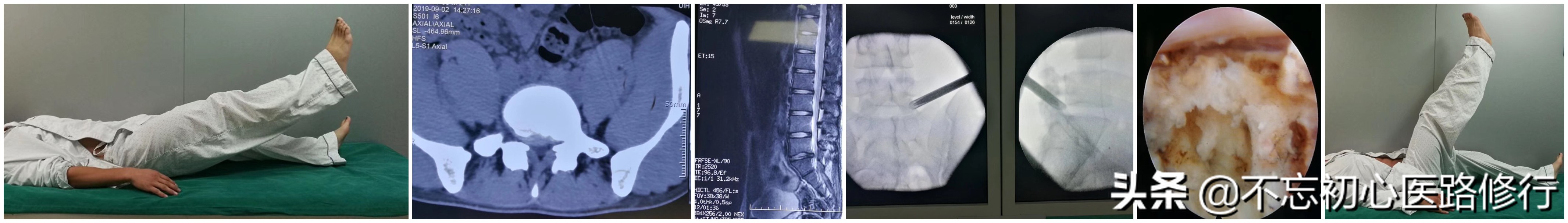治疗腰椎间盘突出的方法与思路,腰椎间盘突出腰腿酸痛多久能好