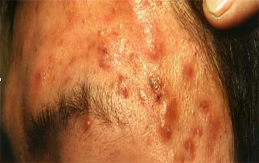 痘痘的周期一般是几天,痘痘的心酸史