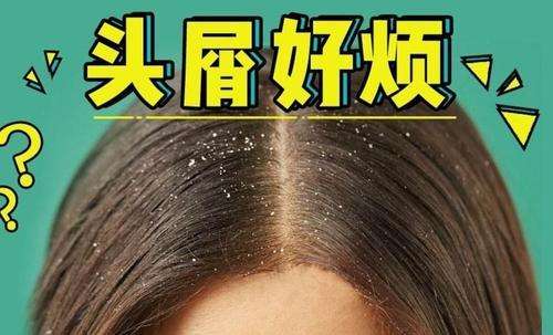 怎样高效解决头油头皮屑掉发问题,解决头油和头皮屑多的洗头方法