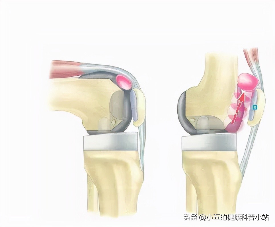 膝关节咔咔响发软是怎么回事,膝关节咔咔响乏力