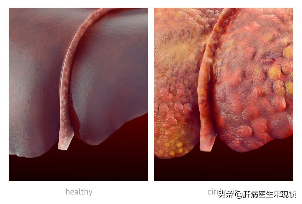肝硬化患者最害怕的5件事,肝硬化禁忌服用什么消炎药