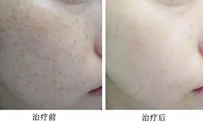 咋办才能祛斑,怎么样才能祛斑最有效方法