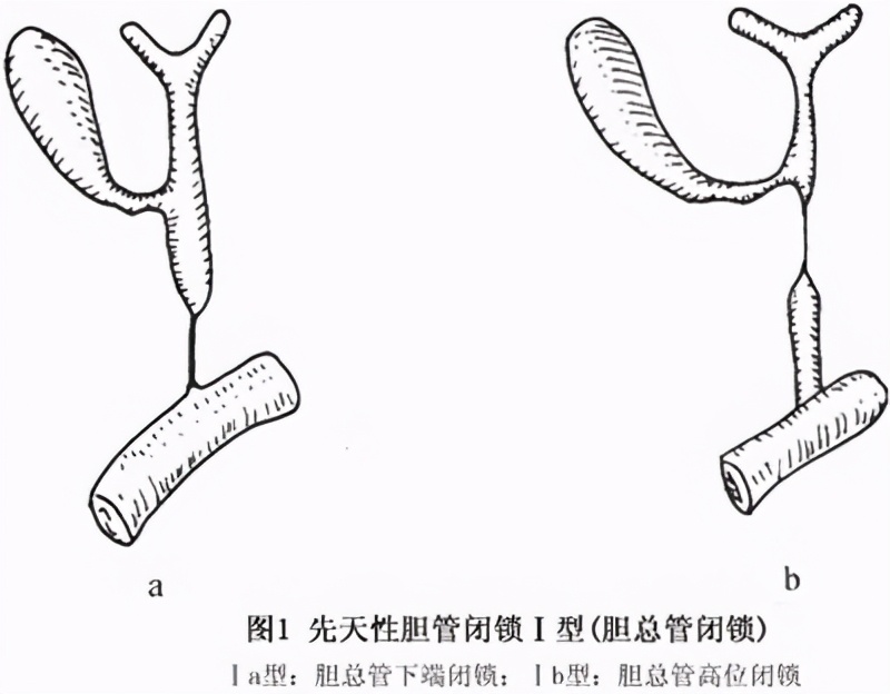 胆管闭锁症状复杂，病症严重，研究探索胆管闭锁，了解治疗详情