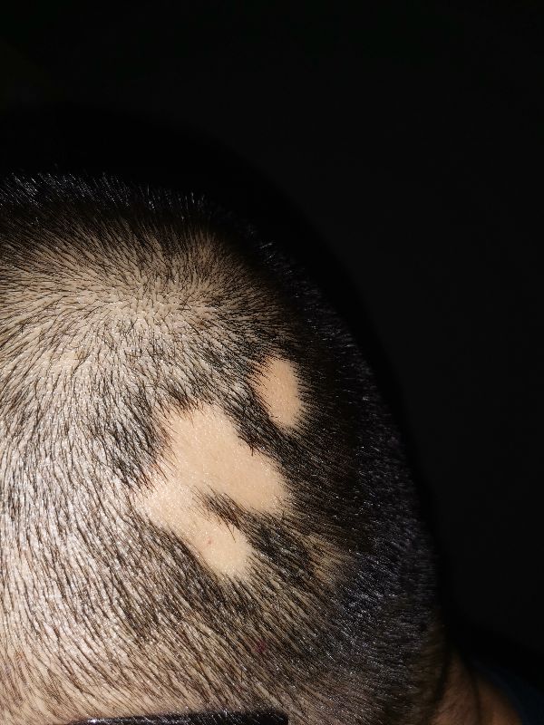 发现斑秃刚好又开始掉头发怎么办,突然发现斑秃怎么治疗