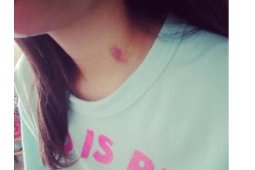 家长发现草莓印怎么办,女儿脖子上有红痕家长该怎么引导