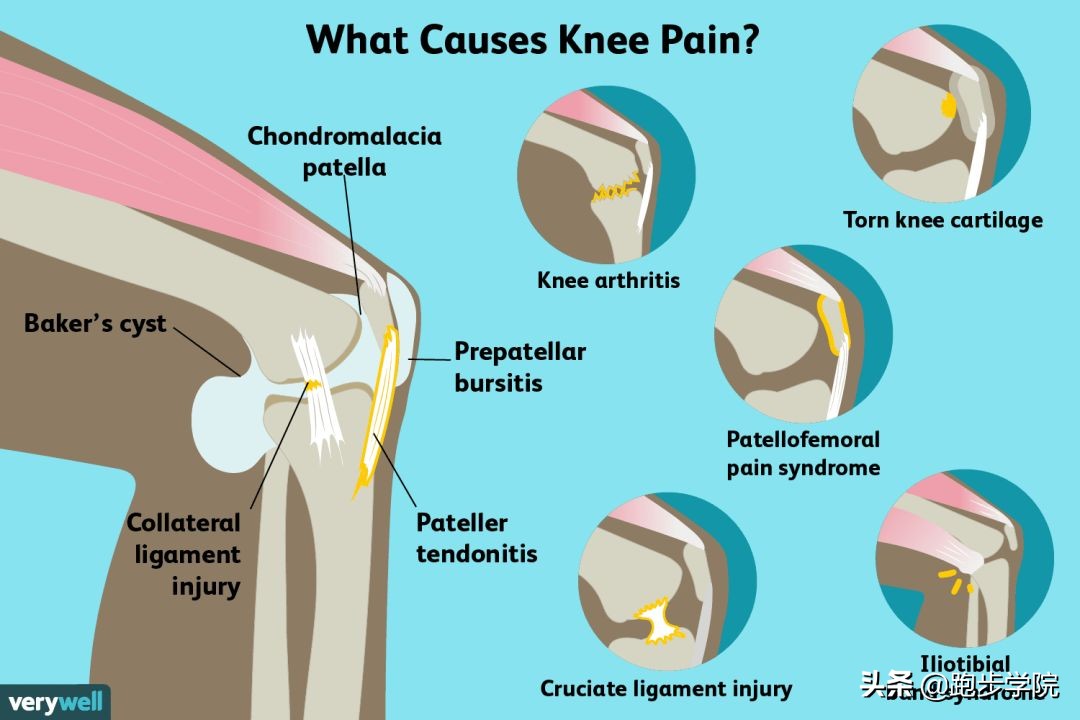如何解决跑步膝,如何拯救膝盖