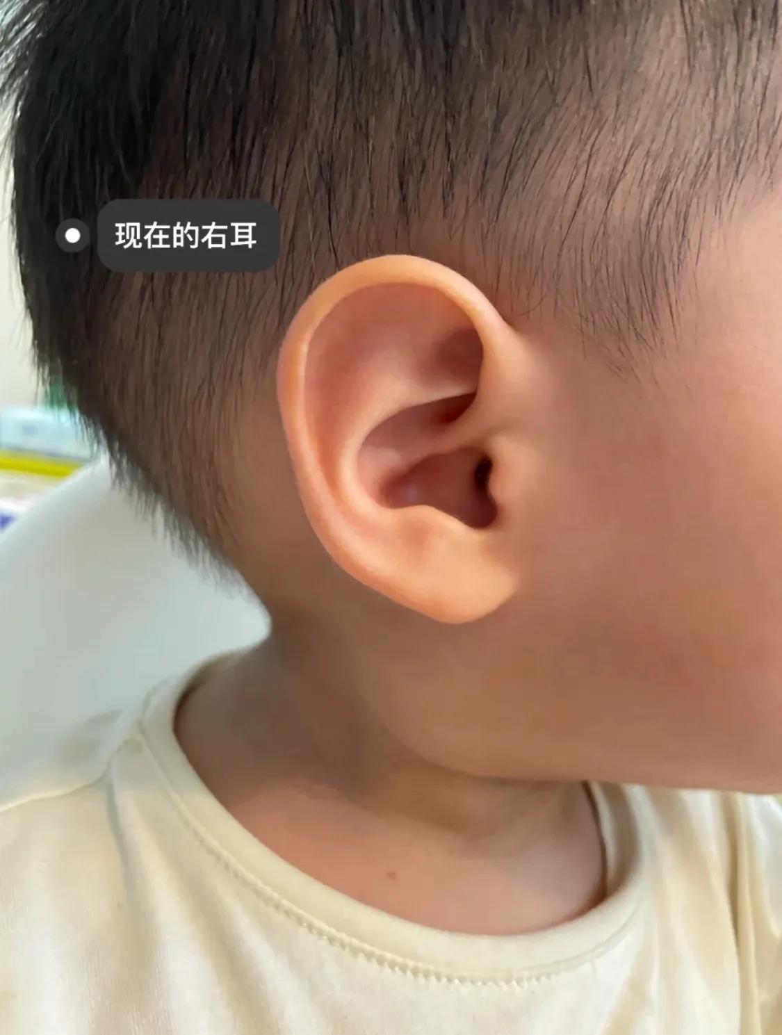 宝宝出生耳廓畸形但是听力正常,刚出生宝宝畸形耳朵图片