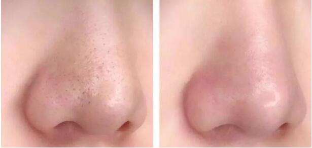 祛黑头神器,祛黑头草莓鼻排行榜第一名