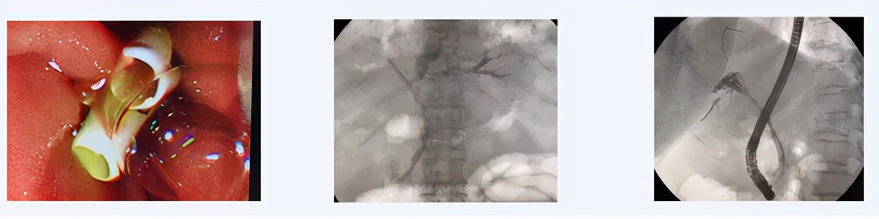 西青医院普通外科医疗团队连续运用ERCP微创技术治疗高危难病患