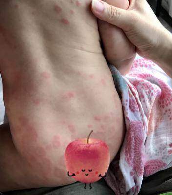 二宝妈妈教你护肤,过敏宝宝的育儿分享