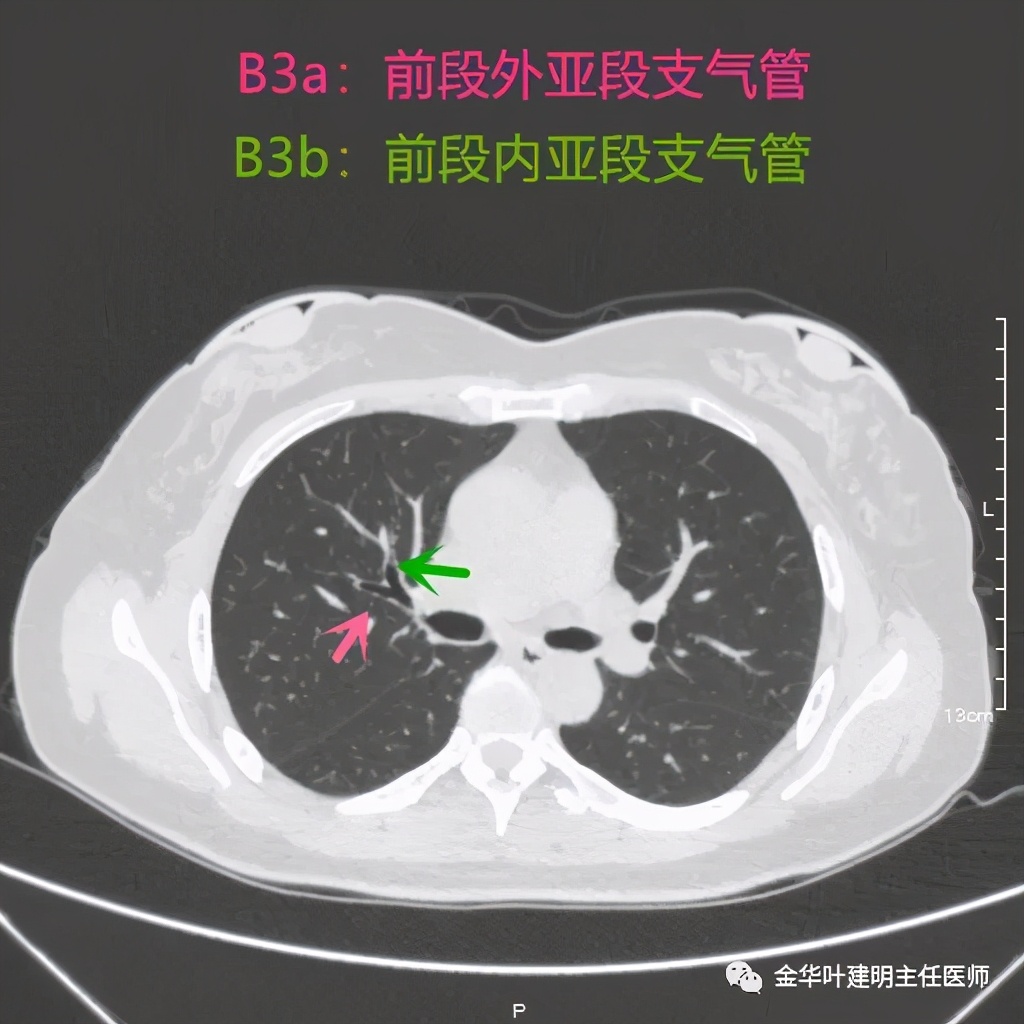 左肺上叶在ct影像上怎么看,平扫ct可以看出肺肿瘤的变化吗