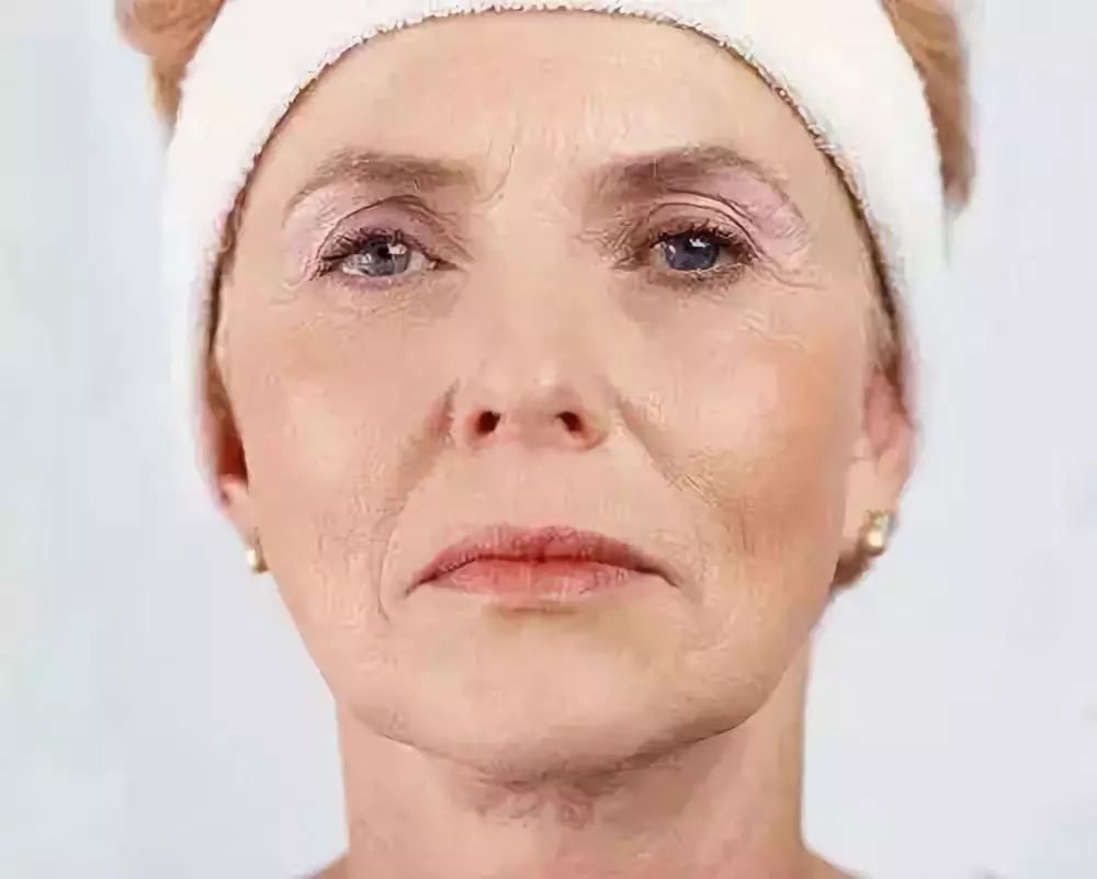 法令纹除皱怎么做效果好,除皱法令纹的最好方法