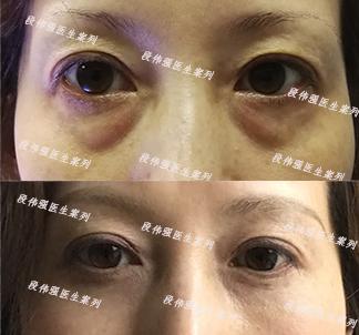 如何消除眼袋呢,如何消除眼袋浮肿