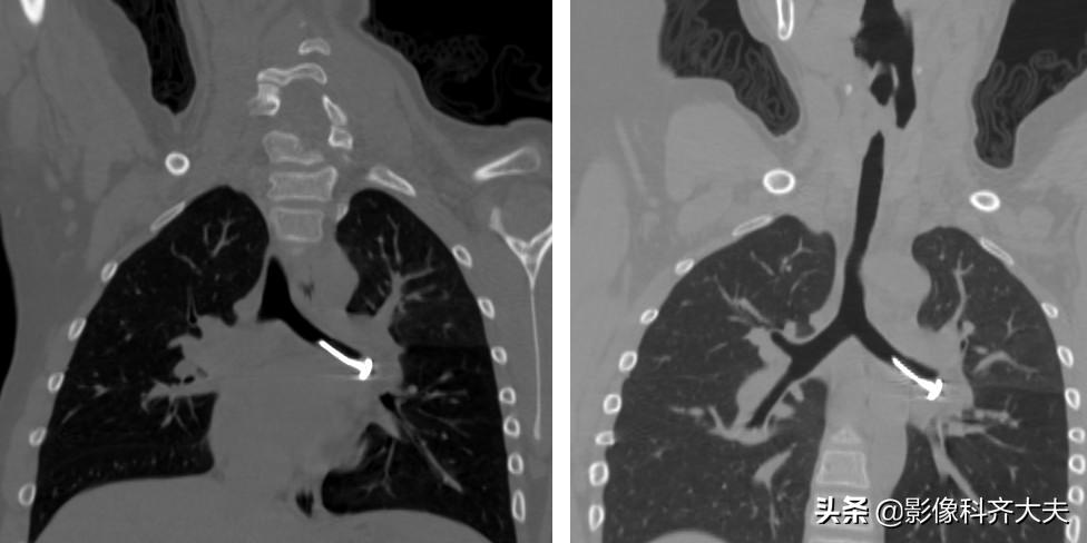孩子支气管异物ct能查出吗,儿童支气管异物诊断方法
