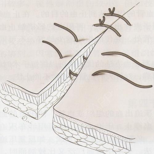 手术拆线后如何护理疤痕会小一点,手术伤口拆线后如何护理