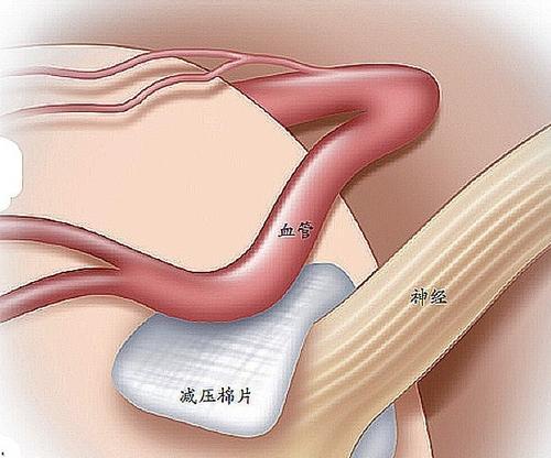 眼皮老是跳怎么回事？神经科医生：这个病要警惕了