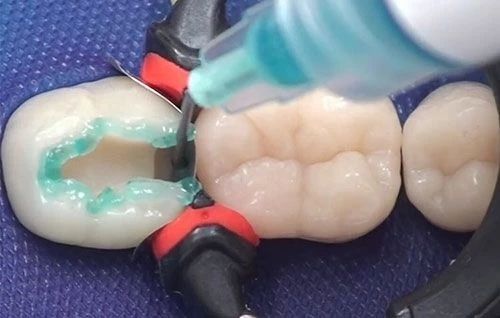 牙缝大该怎么补救,剔牙造成牙缝大怎么补救