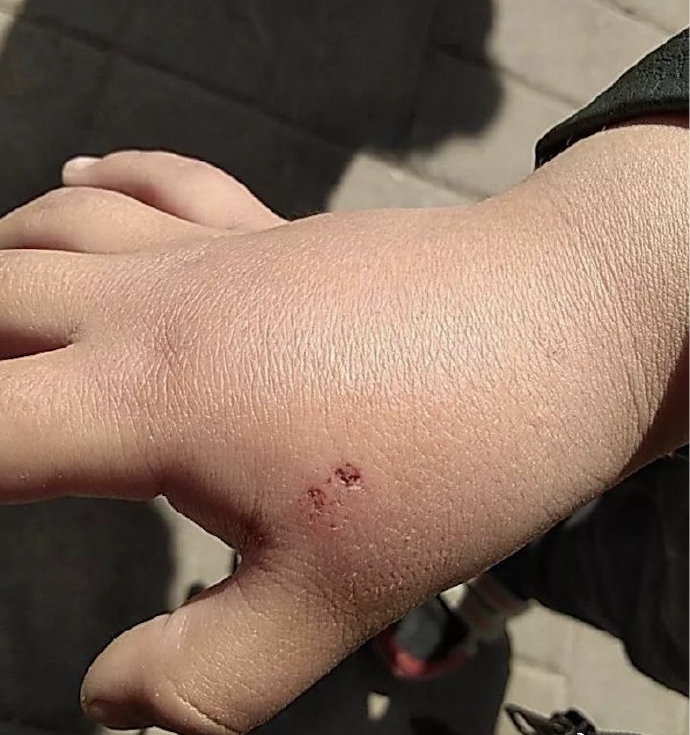 小孩子被老鼠咬伤新闻,五岁小孩被变质病毒老鼠咬伤