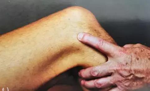 跑步膝盖髂胫束疼痛怎么治疗,跑者最怕的疾病