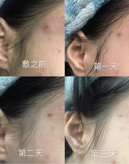 12款热门医美面膜攻略：有人治好皮炎，肤白貌美；有人悔不当初