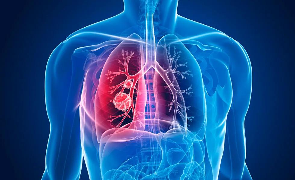 肺癌吉非替尼进展,肺癌靶向药吉非替尼多少钱