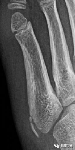 桡骨远端骨折引起尺骨变异,撕脱骨折一个月无明显骨痂形成