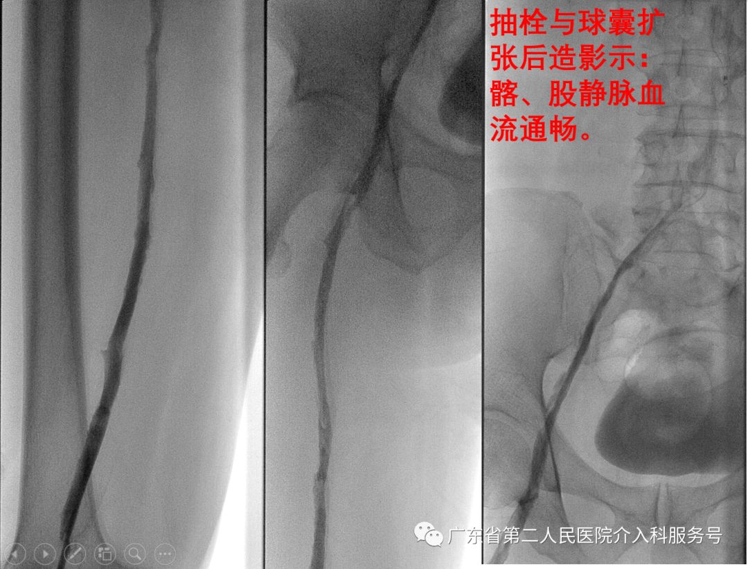 左腿血栓肿胀能完全恢复正常吗,左腿血栓肿痛怎么锻炼