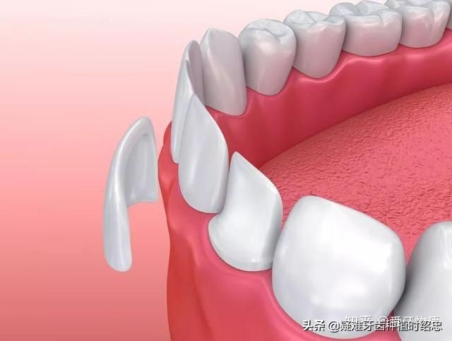 贵的全瓷牙与便宜的有什么区别,便宜的全瓷牙与贵的有什么区别