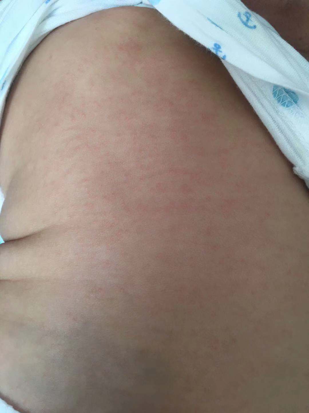 皮肤湿疹预防与护理,肛周湿疹日常护理