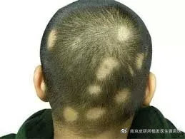 我的头顶感觉凹了怎么回事,我的头顶为什么有点凹陷