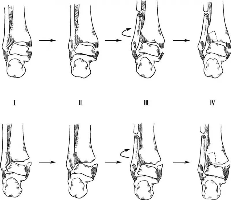 骨折闭合复位髓内钉内固定术,骨折闭合复位
