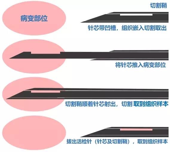 胸部超声引导下穿刺活检术流程,ct引导下肺穿刺活检优缺点