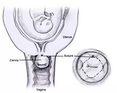 孕21周做宫颈环扎术成功率有多少,孕前腹腔镜宫颈环扎术过程及弊端