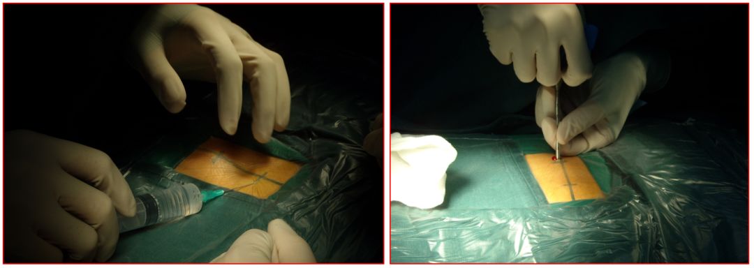 腰椎压缩骨折椎体成形术啥时候做,骨质疏松骨折椎体成形术操作步骤